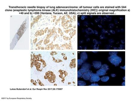 Transthoracic needle biopsy of lung adenocarcinoma: all tumour cells are stained with 5A4 clone (anaplastic lymphoma kinase (ALK) immunohistochemistry.