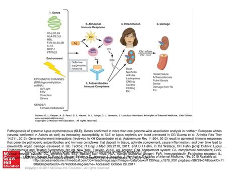 Pathogenesis of systemic lupus erythematosus (SLE)