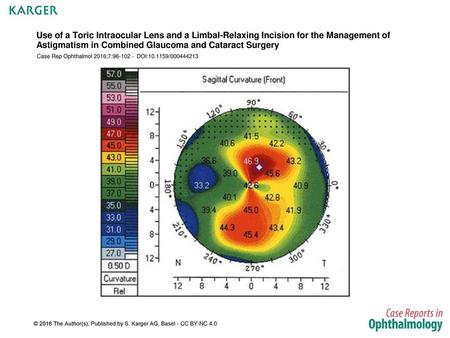 Use of a Toric Intraocular Lens and a Limbal-Relaxing Incision for the Management of Astigmatism in Combined Glaucoma and Cataract Surgery Case Rep Ophthalmol.