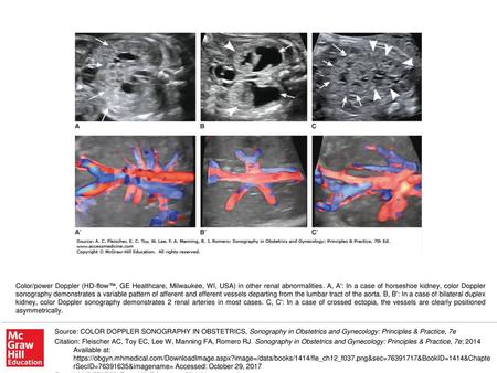 Color/power Doppler (HD-flow™, GE Healthcare, Milwaukee, WI, USA) in other renal abnormalities. A, A': In a case of horseshoe kidney, color Doppler sonography.