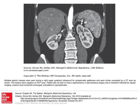 Multiple splenic masses were seen during a right upper quadrant ultrasound for symptomatic gallstones and were further evaluated by a CT scan as shown.