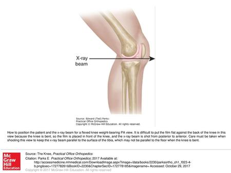 How to position the patient and the x-ray beam for a flexed knee weight-bearing PA view. It is difficult to put the film flat against the back of the knee.