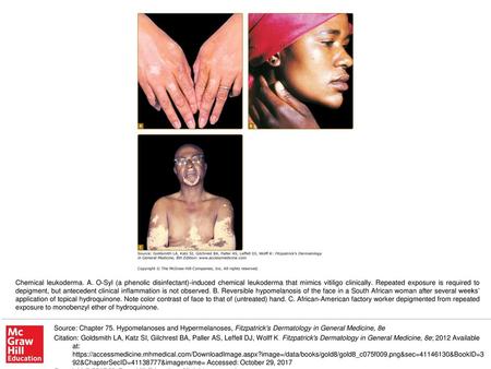 Chemical leukoderma. A. O-Syl (a phenolic disinfectant)-induced chemical leukoderma that mimics vitiligo clinically. Repeated exposure is required to depigment,