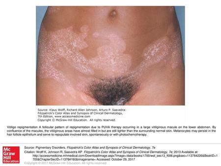 Vitiligo repigmentation A follicular pattern of repigmentation due to PUVA therapy occurring in a large vitiliginous macule on the lower abdomen. By confluence.