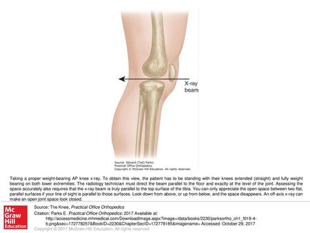 Taking a proper weight-bearing AP knee x-ray