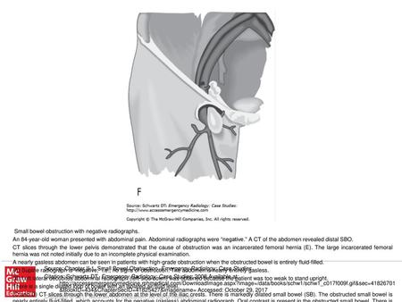 (F) A femoral hernia follows the course of the femoral artery and vein into the anterior thigh inferior to the inguinal ligament. Source: Chapter II-1.