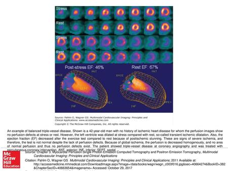 An example of balanced triple-vessel disease