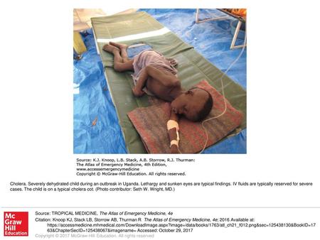 Cholera. Severely dehydrated child during an outbreak in Uganda