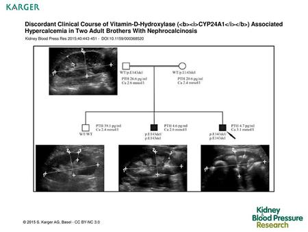 Discordant Clinical Course of Vitamin-D-Hydroxylase (CYP24A1) Associated Hypercalcemia in Two Adult Brothers With Nephrocalcinosis Kidney.