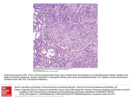 Organizing pneumonia (OP)