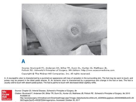 A. A neuropathic ulcer is characterized by a punched-out appearance with loss of sensation in the surrounding skin. The foot may be warm to touch, and.