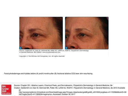 Facial photodamage and rhytides before (A) and 6 months after (B) fractional ablative CO2 laser skin resurfacing. Source: Chapter 251. Ablative Lasers,