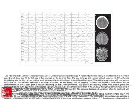 Late posttraumatic epilepsy usually occurs within the first 2 years after the injury. Seizures are believed to originate from a cerebromeningeal scar.26.