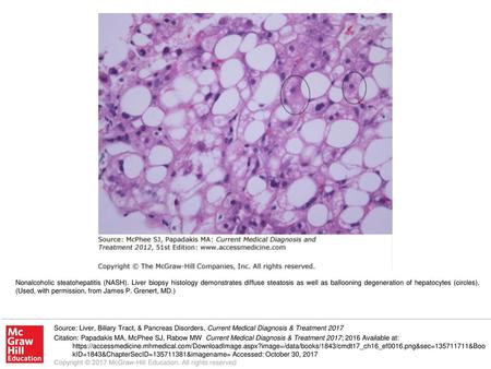 Nonalcoholic steatohepatitis (NASH)