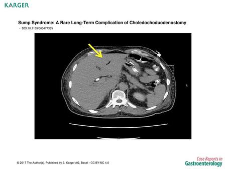 Sump Syndrome: A Rare Long-Term Complication of Choledochoduodenostomy