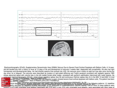 Focal cortical dysplasia (FCD) is often associated with severe focal epilepsy. Intraoperative ECoG showed one of the following patterns: (1) repetitive.