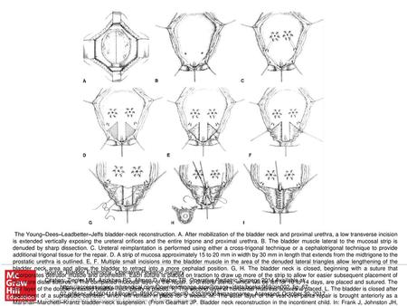 The Young–Dees–Leadbetter–Jeffs bladder-neck reconstruction. A