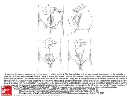 Drawings of the preferred operative procedure, single or multiple stages. A. The ileocecal plate is closed demonstrating preservation of the appendix,