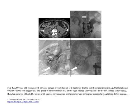 Fig. 4. A 69-year-old woman with cervical cancer given bilateral D-J stents for double-sided ureteral invasion. A. Malfunction of both D-J stents was suggested.