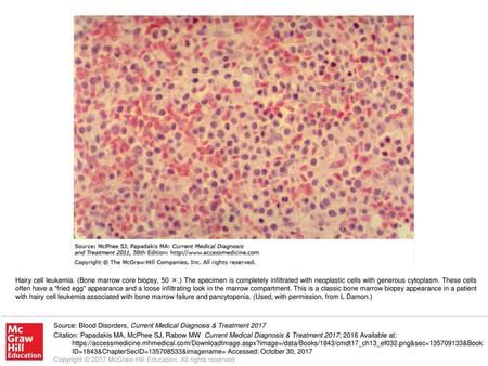 Hairy cell leukemia. (Bone marrow core biopsy, 50 ×