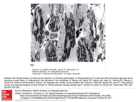 Newborn with Pompe disease. (a) Note severe hypotonia