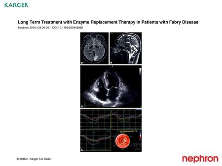 Long Term Treatment with Enzyme Replacement Therapy in Patients with Fabry Disease Nephron 2016;134:30-36 - DOI:10.1159/000448968 Fig. 1. Representative.