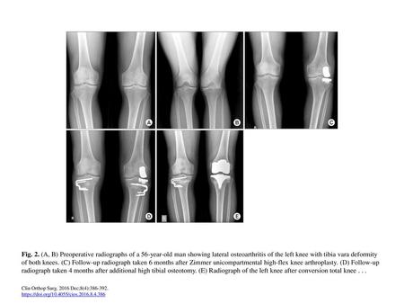 Fig. 2. (A, B) Preoperative radiographs of a 56-year-old man showing lateral osteoarthritis of the left knee with tibia vara deformity of both knees. (C)