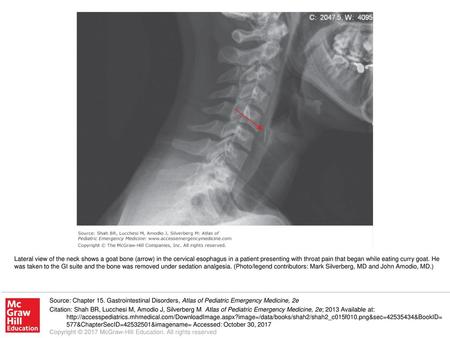 Lateral view of the neck shows a goat bone (arrow) in the cervical esophagus in a patient presenting with throat pain that began while eating curry goat.