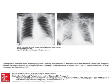 Development of transfusion-related acute lung injury (TRALI) following blood transfusion. A. Pre transfusion; B. Post-transfusion showing rapid emergence.