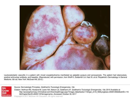 Leukocytoclastic vasculitis in a patient with mixed cryoglobulinemia manifested as palpable purpura and acrocyanosis. The patient had tuberculosis, positive.