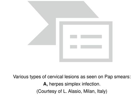 Various types of cervical lesions as seen on Pap smears: