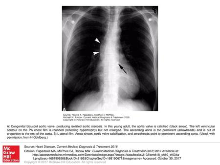 A: Congenital bicuspid aortic valve, producing isolated aortic stenosis. In this young adult, the aortic valve is calcified (black arrow). The left ventricular.