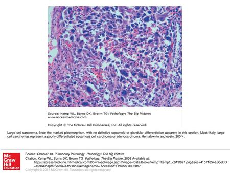 Large cell carcinoma. Note the marked pleomorphism, with no definitive squamoid or glandular differentiation apparent in this section. Most likely, large.