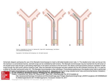 Schematic diagram portraying the use of the fiberoptic bronchoscope to insert a left-sided double-lumen tube. A. The double-lumen tube can be put into.