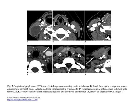 Fig. 7. Suspicious lymph nodes (CT features). A