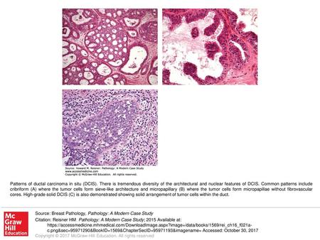 Patterns of ductal carcinoma in situ (DCIS)