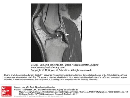 Chronic grade 3, complete ACL tear