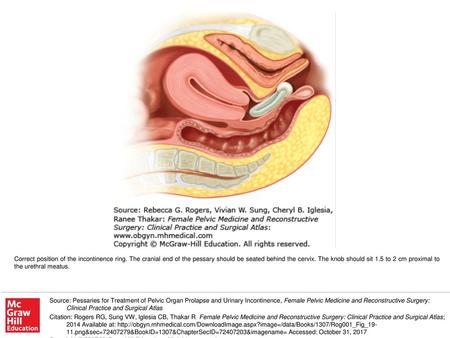 Correct position of the incontinence ring