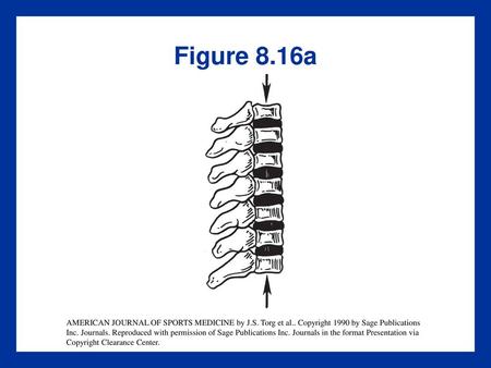 Figure 8.16a AMERICAN JOURNAL OF SPORTS MEDICINE by J.S. Torg et al.. Copyright 1990 by Sage Publications Inc. Journals. Reproduced with permission of.