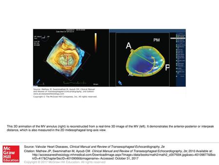 This 3D animation of the MV annulus (right) is reconstructed from a real-time 3D image of the MV (left). It demonstrates the anterior-posterior or interpeak.