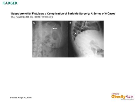 Gastrobronchial Fistula as a Complication of Bariatric Surgery: A Series of 6 Cases Obes Facts 2012;5:538–545 - DOI:10.1159/000342012 Fig. 1.A Plain abdominal.