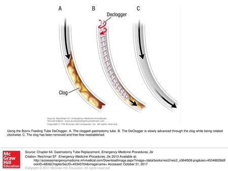 Using the Bionix Feeding Tube DeClogger. A