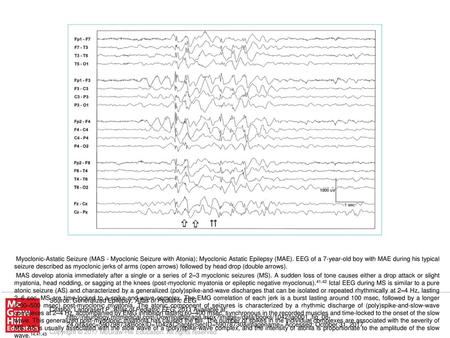 MAS develop atonia immediately after a single or a series of 2–3 myoclonic seizures (MS). A sudden loss of tone causes either a drop attack or slight myatonia,