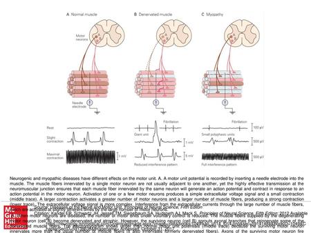 C. When muscle is diseased the number of muscle fibers in each motor unit is reduced. Some muscle fibers innervated by the two motor neurons shrink and.