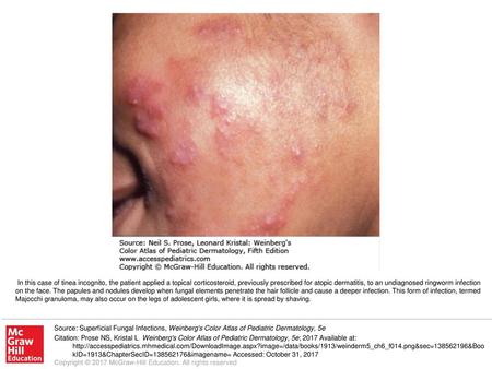 In this case of tinea incognito, the patient applied a topical corticosteroid, previously prescribed for atopic dermatitis, to an undiagnosed ringworm.