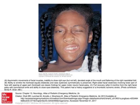 (A) Asymmetric movements of facial muscles, inability to close right eye (but not left), deviated angle of the mouth and flattening of the right nasolabial.