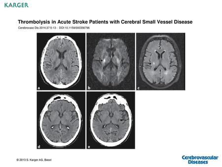 Cerebrovasc Dis 2014;37: DOI: /