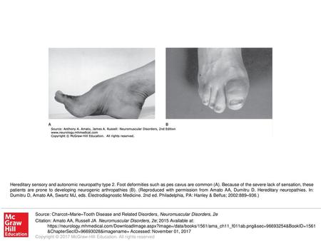 Hereditary sensory and autonomic neuropathy type 2