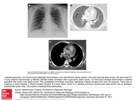 Calcified granuloma. (A) Frontal chest radiograph demonstrates a tiny well-defined nodular opacity in the right mid lung (black arrow). (B) Axial chest.