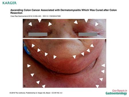 Case Rep Gastroenterol 2016;10:338– DOI: /